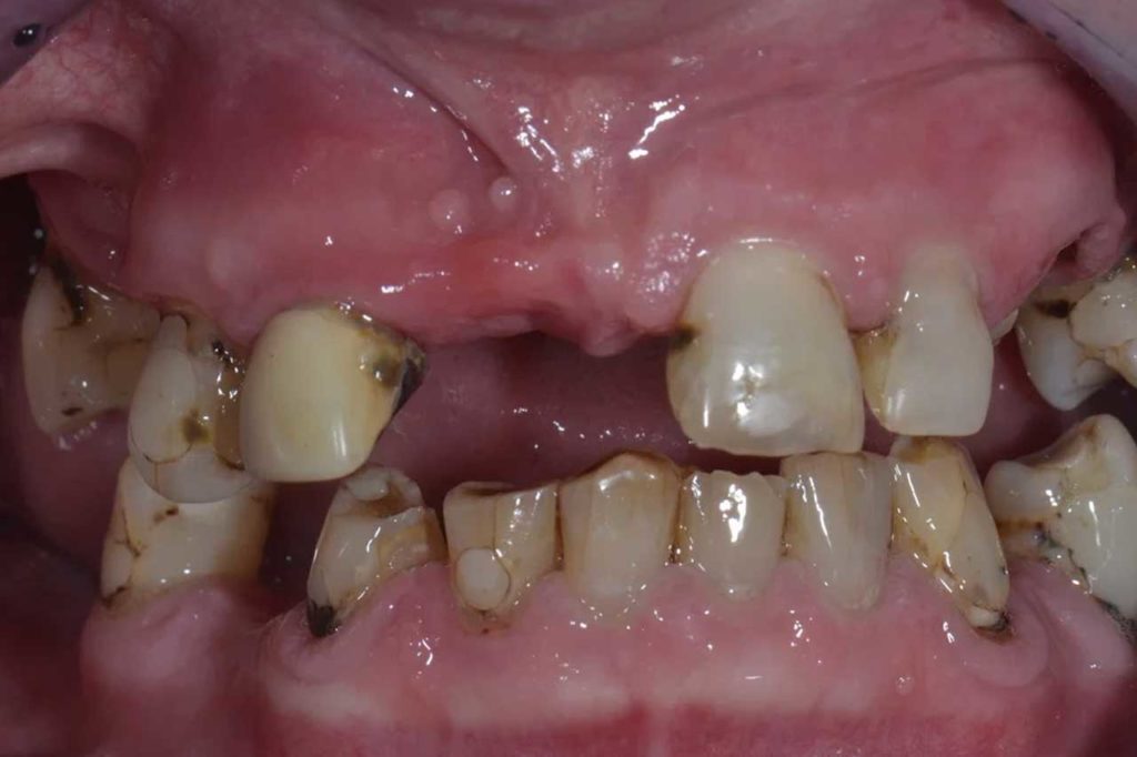 Protezy zębów