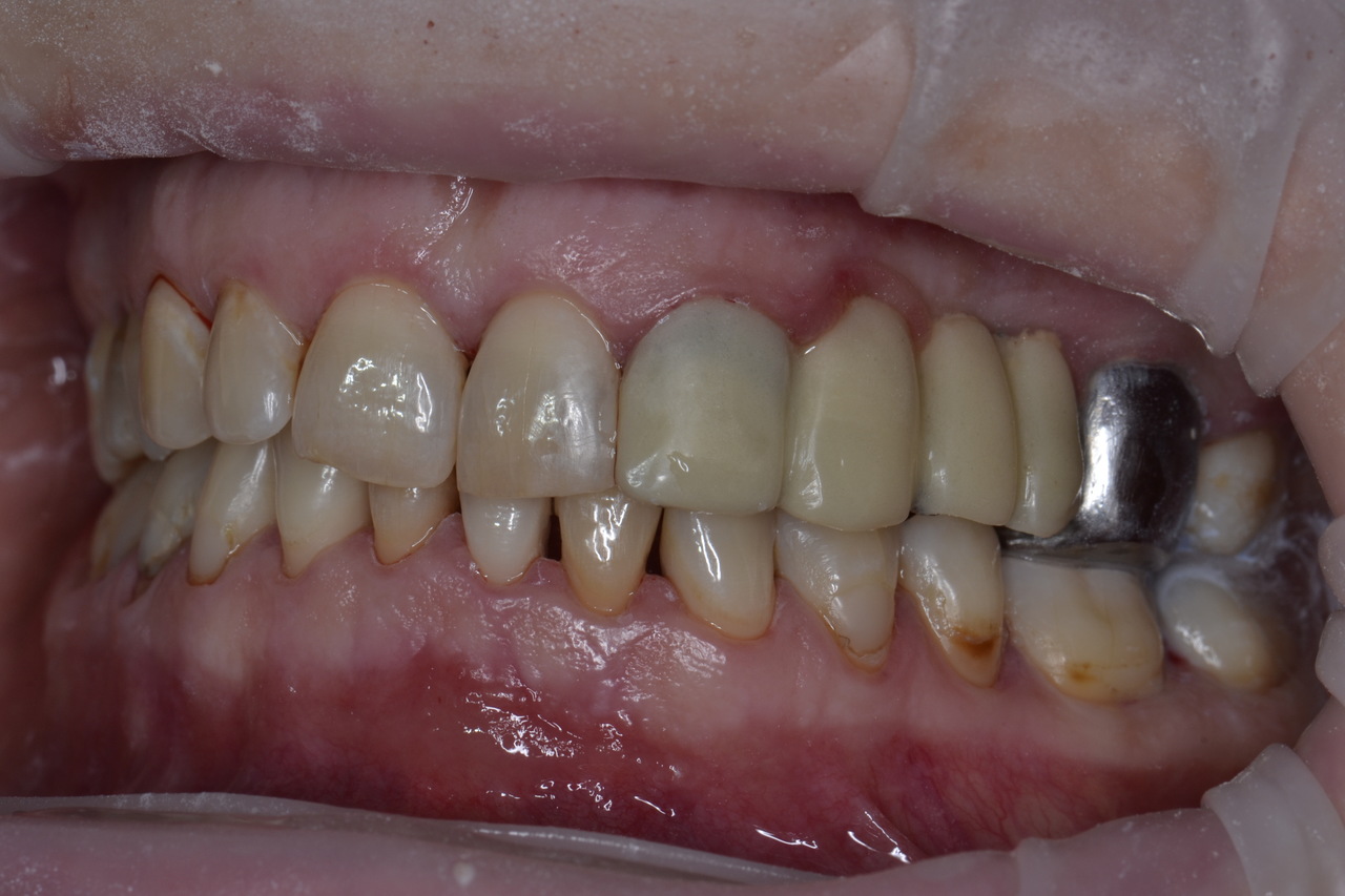 Pani Luiza zmniejszone zdjecia 1 Prywatny stomatolog Jarosław | kompleksowe leczenie zębów | Implanty zębów